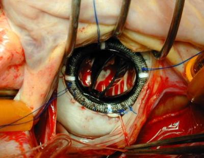operácia - implantácia mechanickej chlopne
