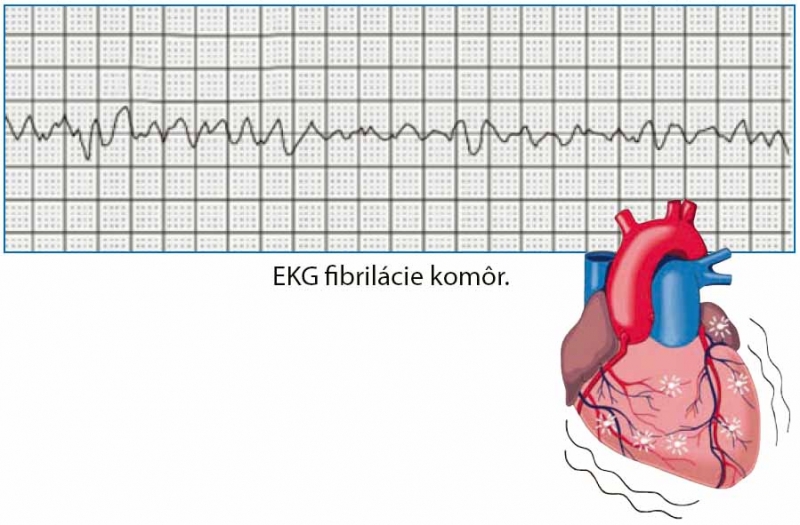 Fibrilácie komôr